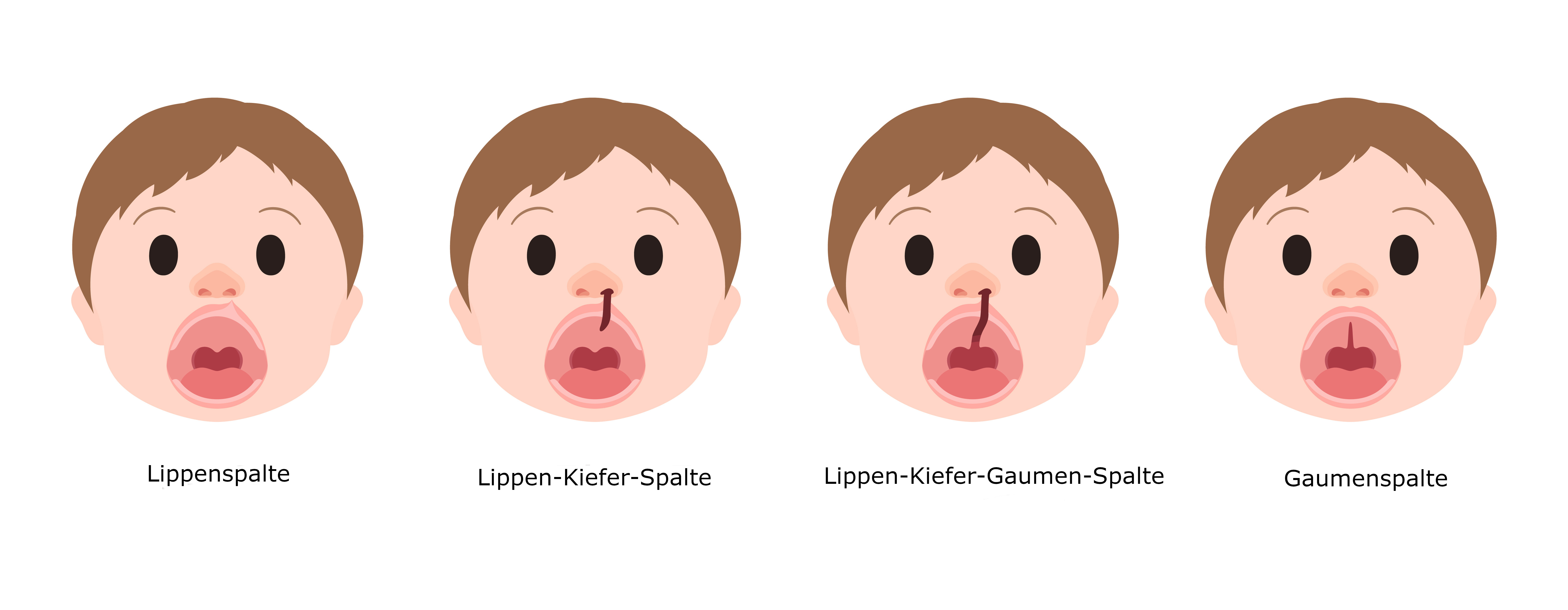 Symbolbild Spaltbildung