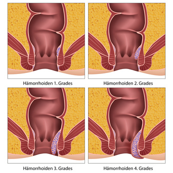 Erkrankungsgrade Hämorrhoiden
